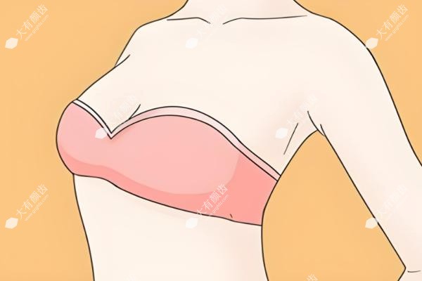 触感大比拼！假体硬如石vs脂肪软如棉？真人隆胸术后手感反馈实录