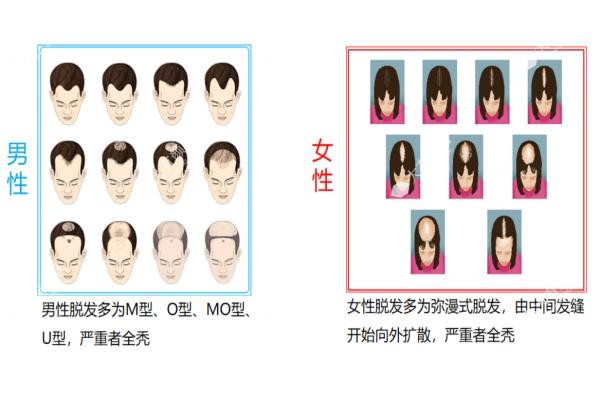 cgf治疗脱发和植发哪个好