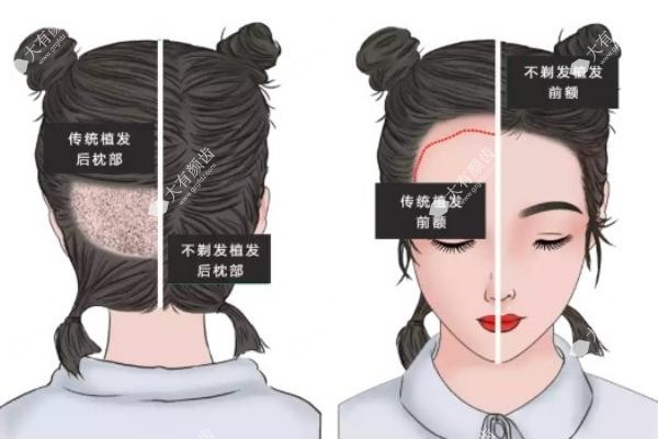植发际线半年后<span style=