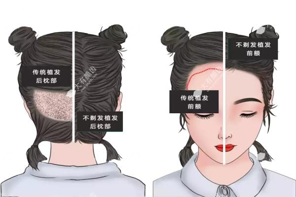 不剃发植发成活率高么？.jpg
