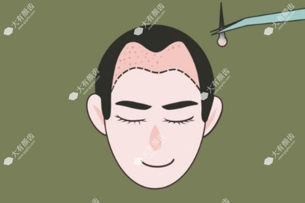 重庆十大植发正规医院排行榜分享:碧莲盛/美姿/唐森/华美口碑爆棚!.jpg