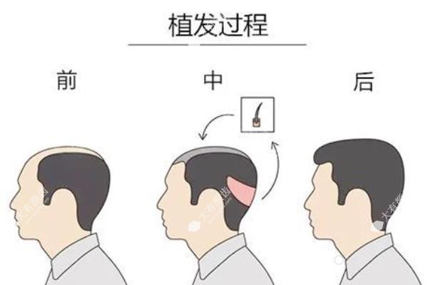 植发医院哪家好