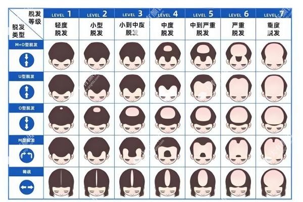 脱发1-7级程度图片