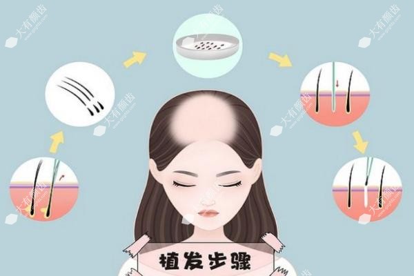 疤痕植发后头发多久正常生长