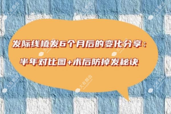 发际线植发6个月后的变化