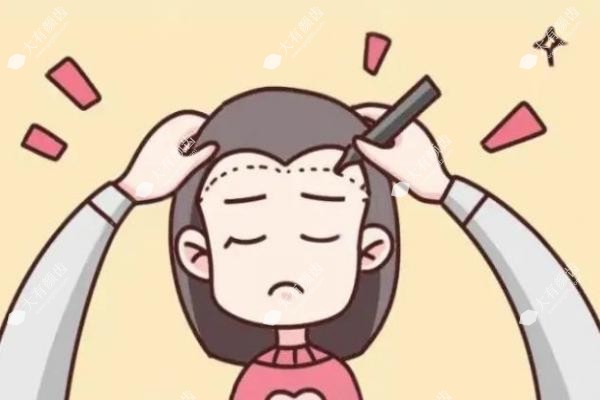 发际线植发后还会掉吗