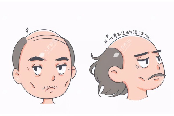 非那雄胺治疗脱发真实<span style=