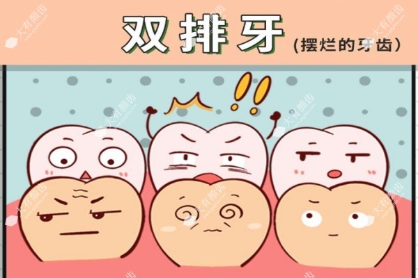 儿童双排牙要立刻拔吗1.jpg