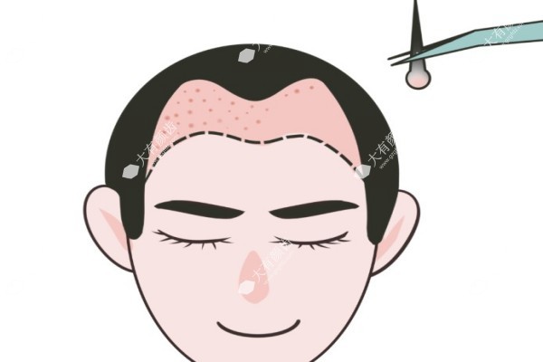 发际线种植一般需要多少钱呢1.jpg