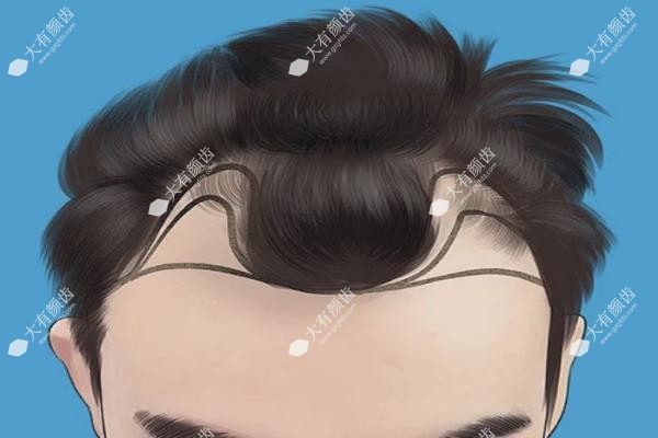 M型发际线植发真实经历.jpg