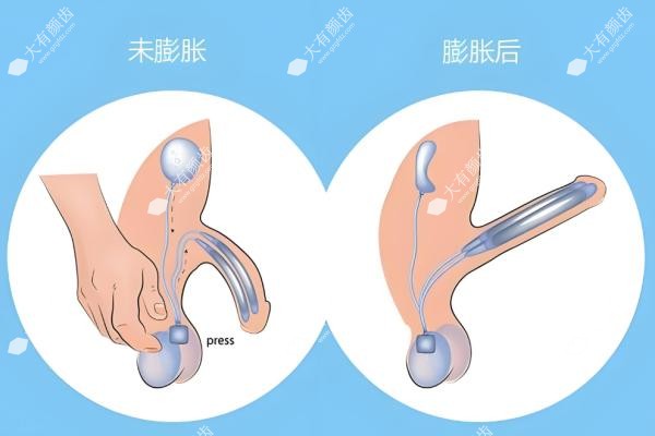 男性假体三件套植入手术哪家医院好