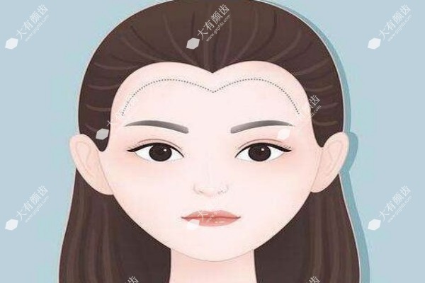 发际线种植一般需要多少钱呢3.jpg