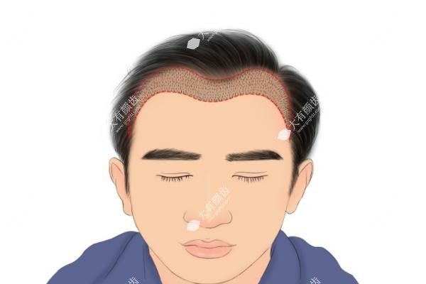 M型发际线植发真实经历.jpg