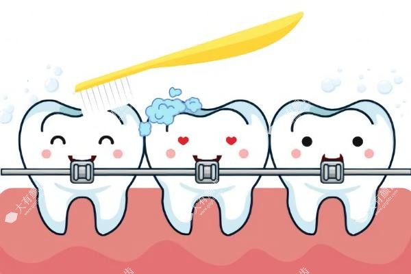 MRC牙齿矫正器怎么选择型号