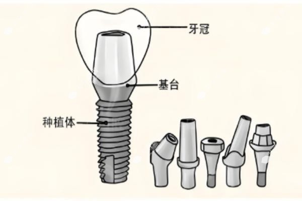 镶一颗后槽牙需要多少钱呢.jpg