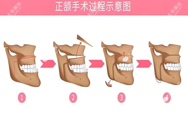 西安正颌手术医院医生前十排名盘点!选对少走三年弯路(附地址+技术亮点3
