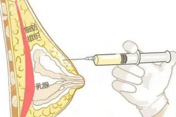 奥美定注射隆胸30年不取行不行.jpg